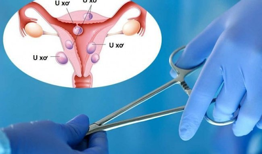 Phẫu thuật bóc tách khối u vẫn đảm bảo khả năng mang thai cho phụ nữ